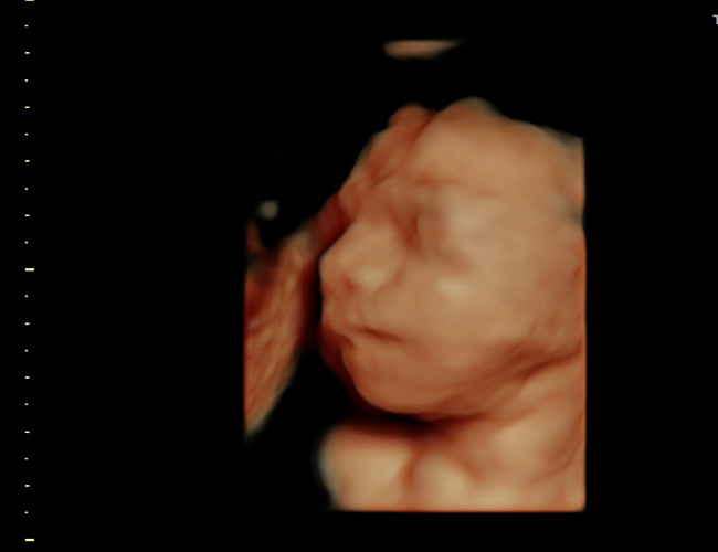 3D ultrasound image at 25 weeks